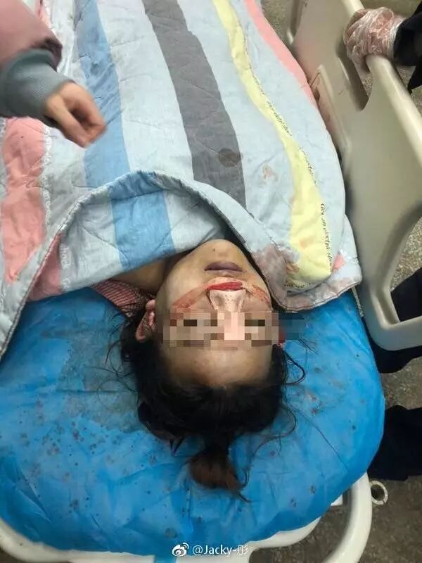 19岁女孩隆鼻手术后死亡，悲剧背后的反思