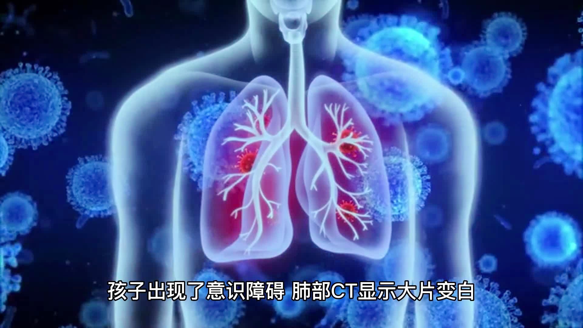 男子甲流后发烧一查变成病毒性肺炎