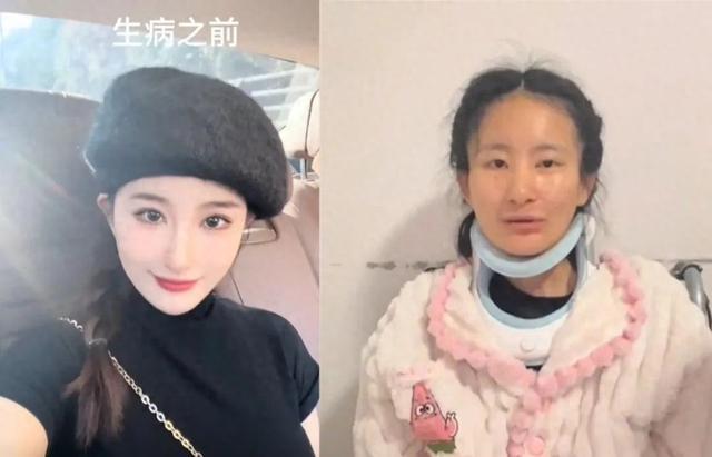 女生确诊渐冻症一年容貌巨变，挑战与希望