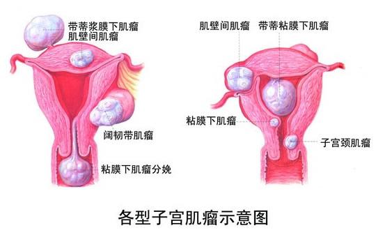 震撼！39岁女子竟长出36枚子宫肌瘤，真相究竟如何？